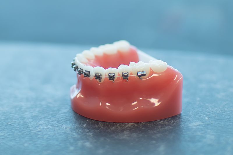 Comparing Other Orthodontic Treatment Options And Prices